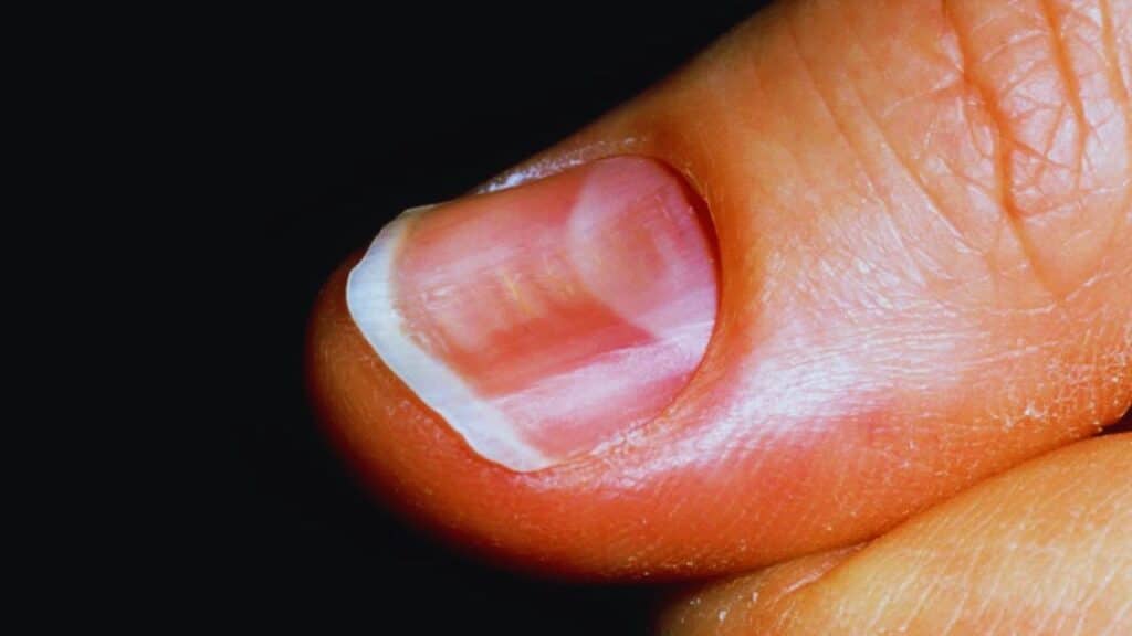 Brittle Nails Anemia Health Signs