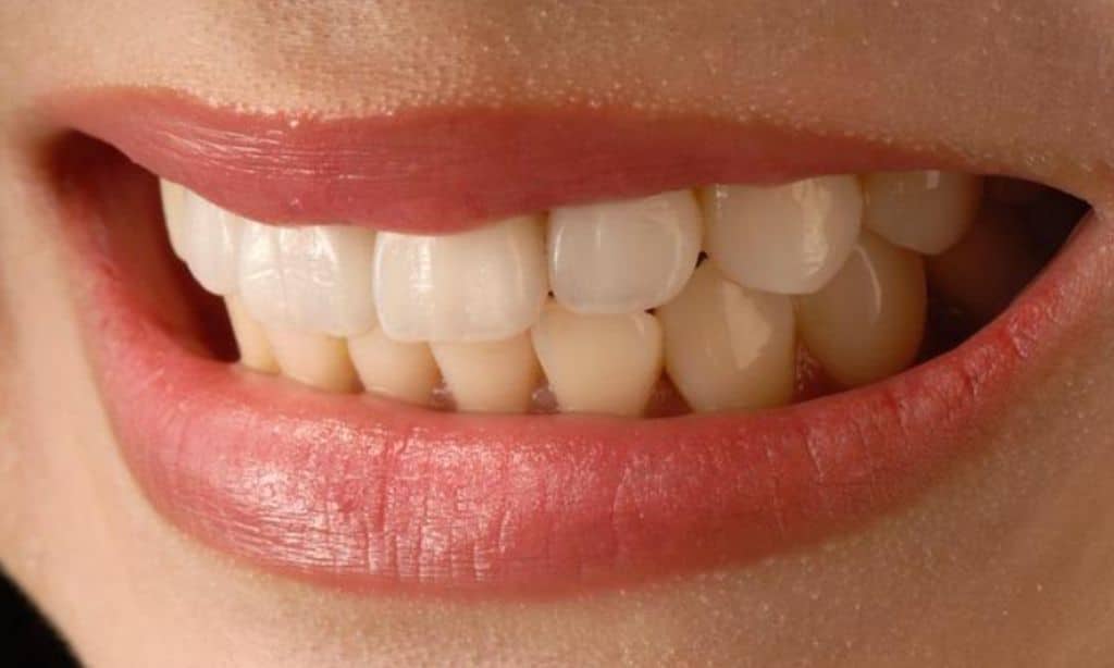 What Are Veneers