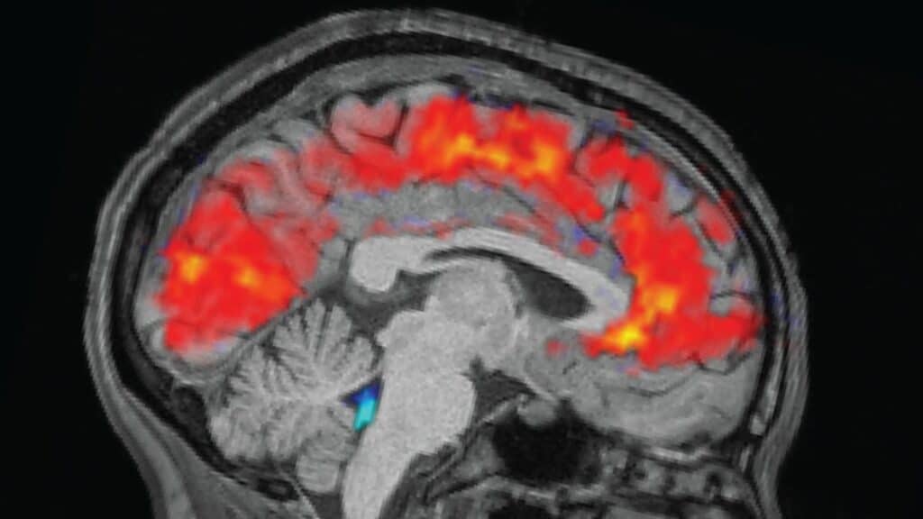 fMRI Brain Scans Misread