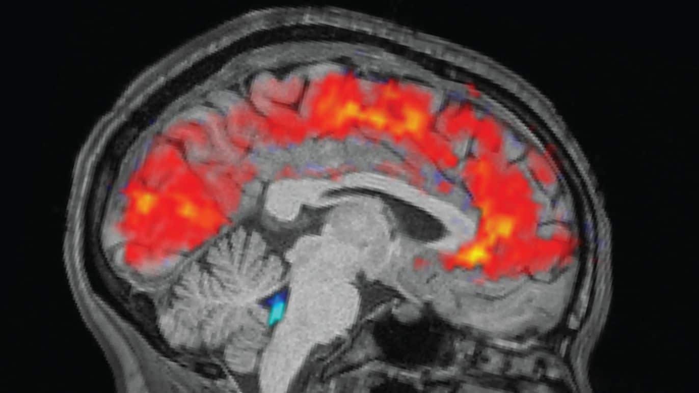 fMRI Brain Scans Misread